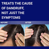 Sebizole 2% Shampoo – Anti-Dandruff & Scalp Treatment